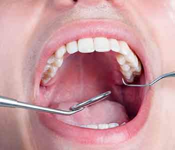 Amalgam Filling Removal Greer from Palmer Distinctive Dentistry