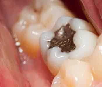 Remove Amalgam Fillings Greer from Palmer Distinctive Dentistry
