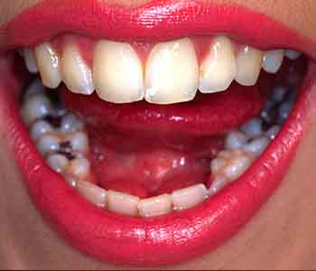 Palmer Distinctive Dentistry Provides Safe Amalgam Fillings Removal Greenville